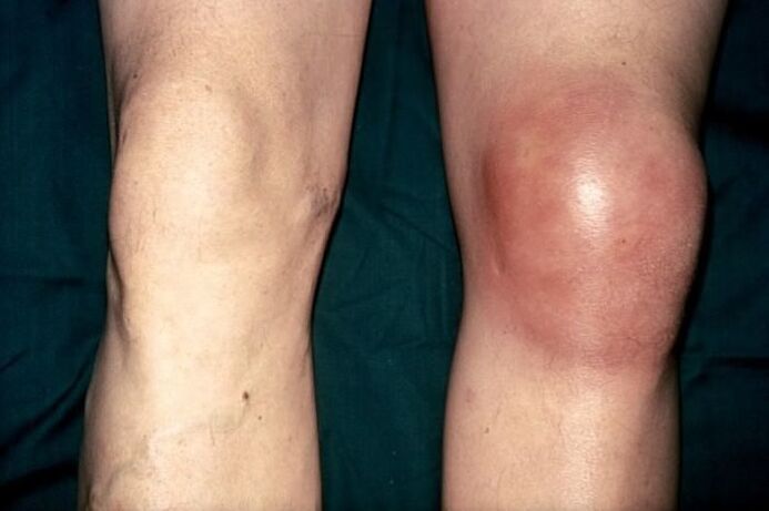 healthy knees and swollen due to pain