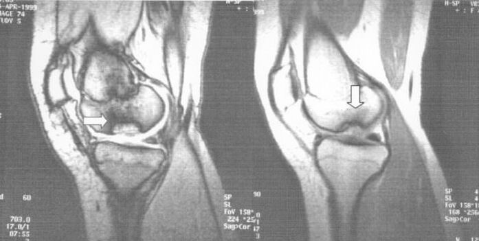 x-ray osteochondrosis dissecans at the knee joint