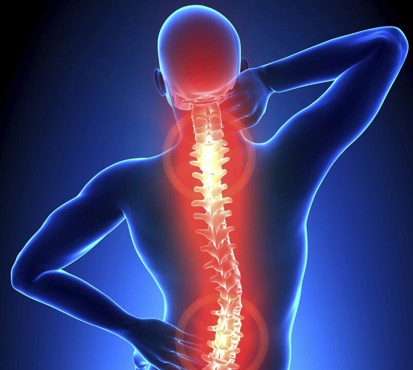 Spinal osteochondrosis